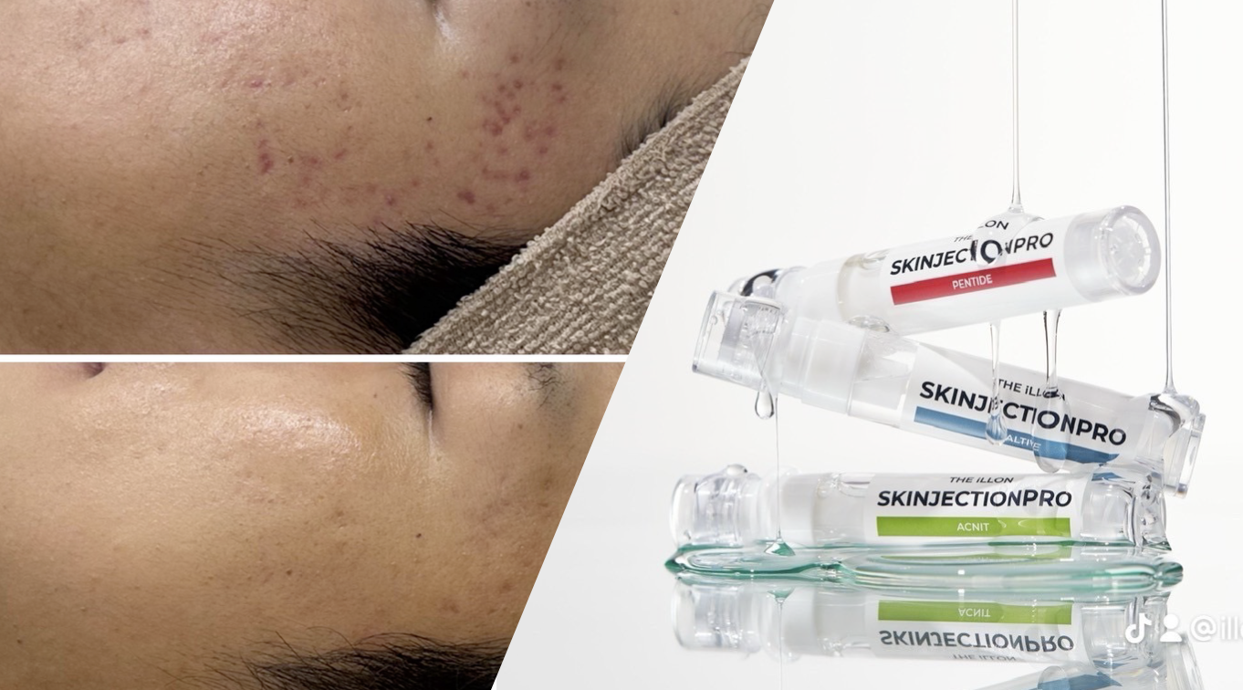 Silk式スキンインジェクション