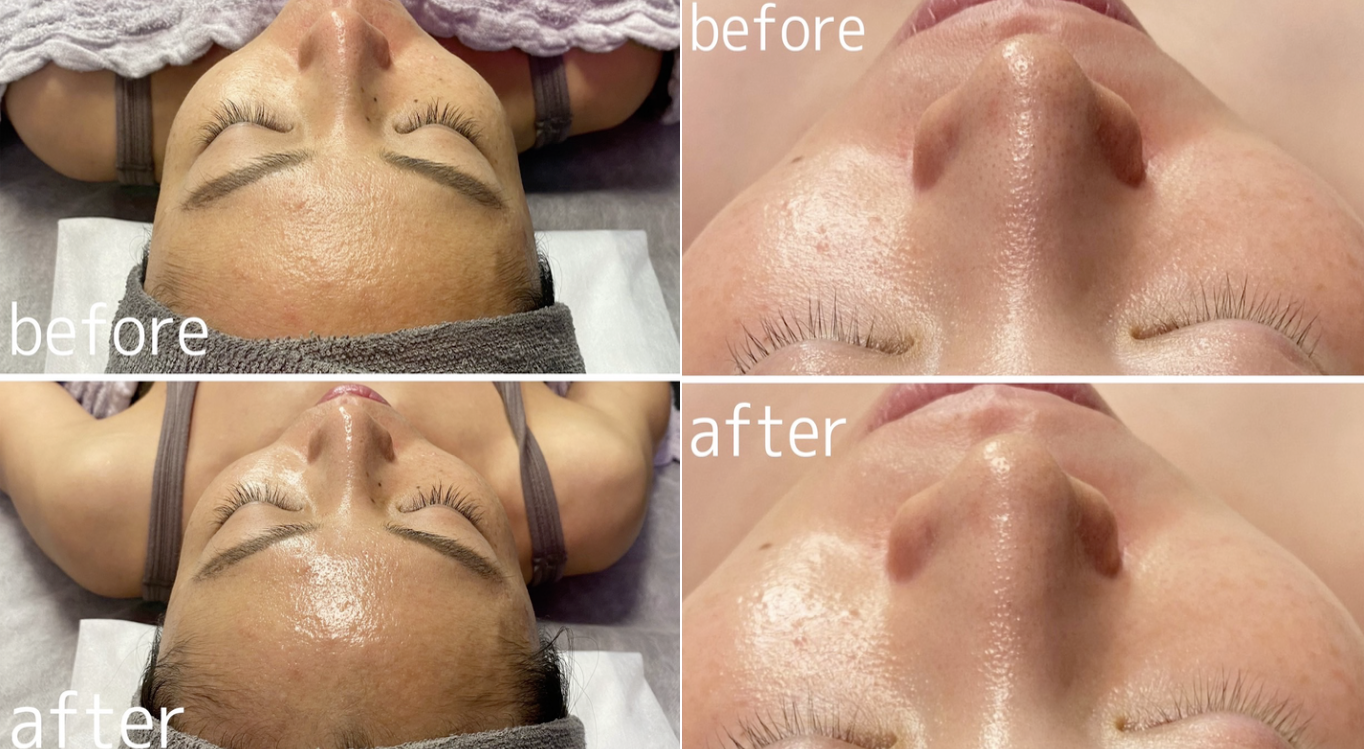 Silk式エアインジェクション