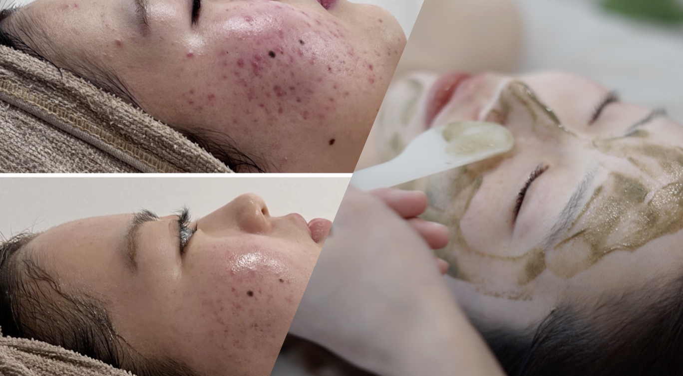 スピキュール肌再生トリートメント